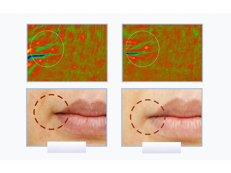 Anlan Ultrasonic facial massager with light therapy